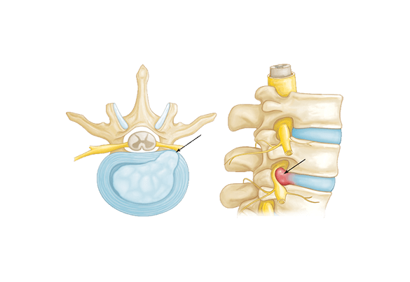 Hérnia de Disco